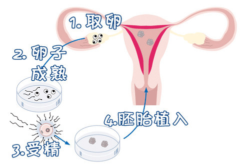 白色妊娠纹