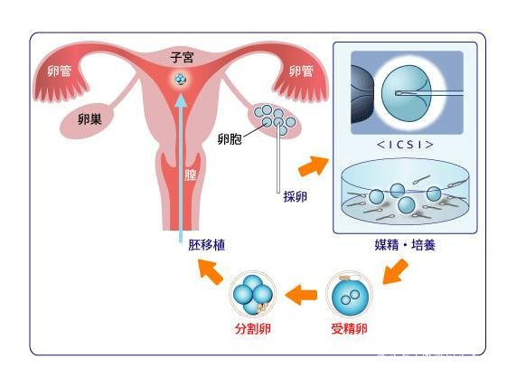 胚胎移植